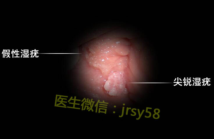 濕銳尖疣是什么，深入了解與應對，濕銳尖疣詳解，了解、應對與防范之道